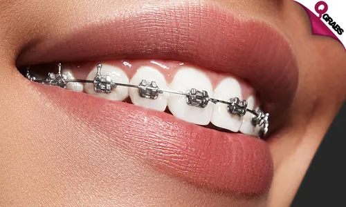 Metal Dental Braces!